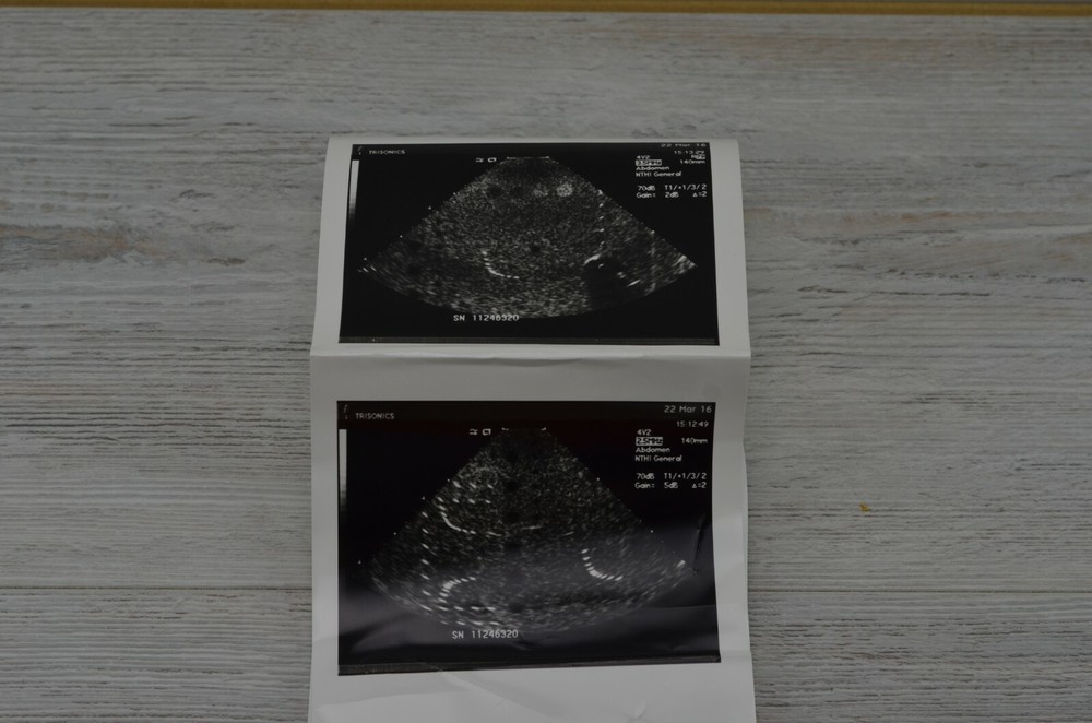 Siemens Acuson 4V2 Vector Array Transducer / Probe for Acuson Aspen Ultrasound