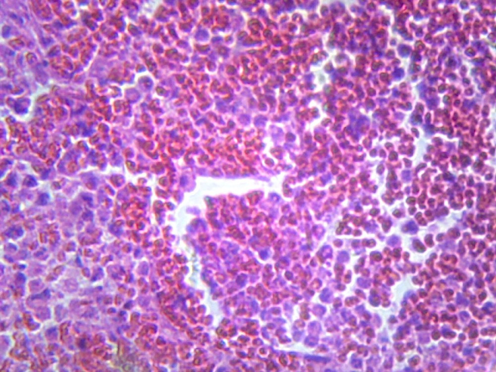 Pneumonia (Human Respiratory System); Section; H&E Stain