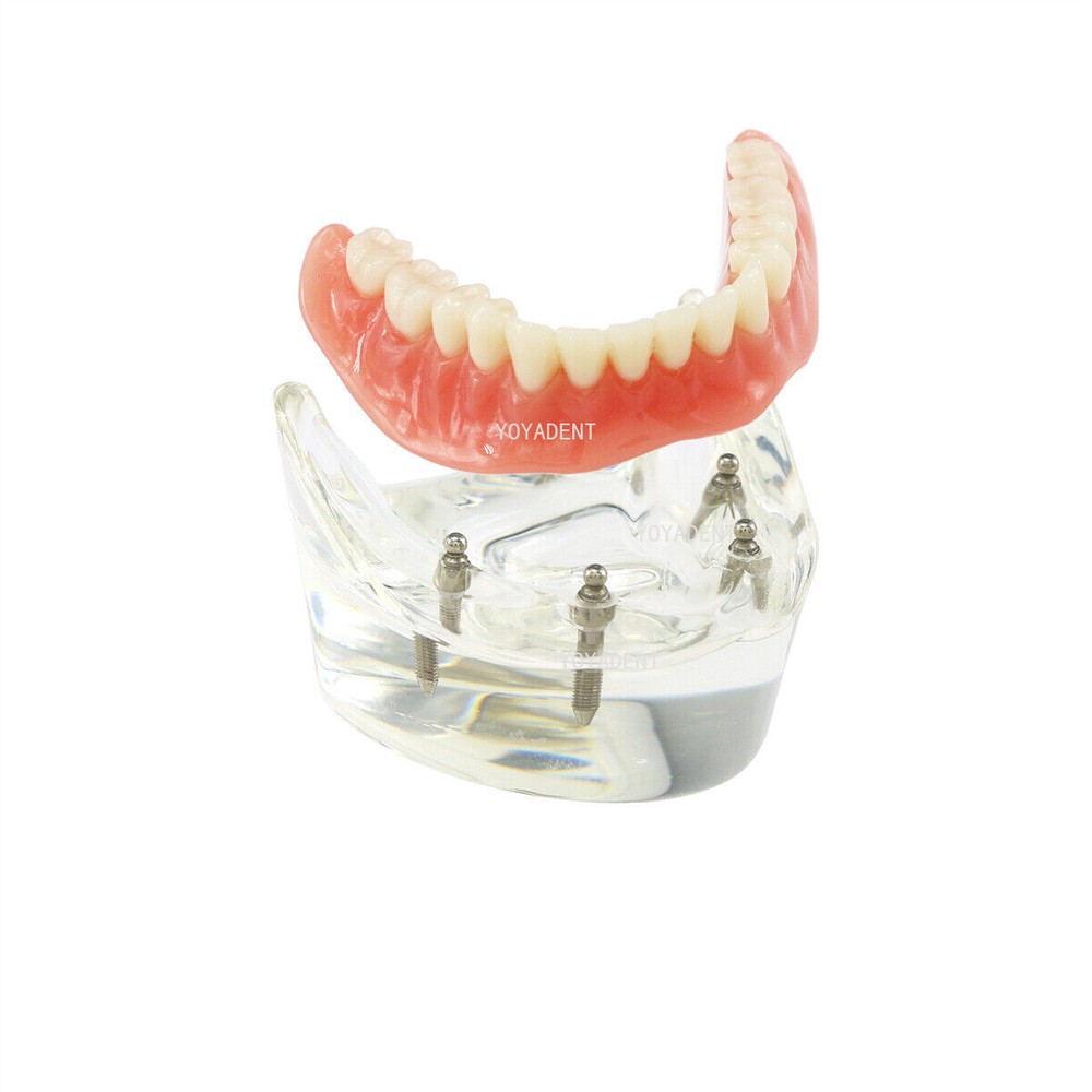 Dental Teeth Model Removable Overdenture Teeth Upper/Lower Jaw 4 Implants Model