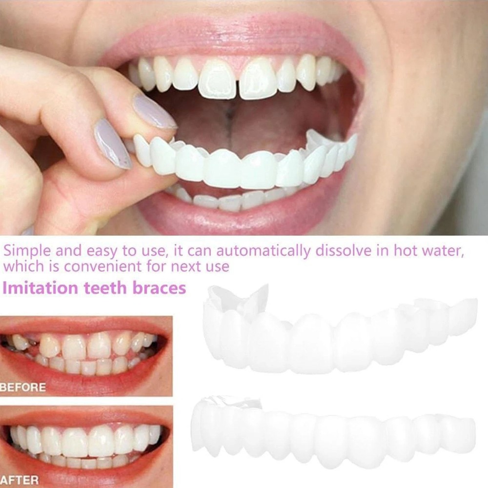 Professional Snap-On Denture Set - Upper & Lower False Teeth with Veneer Covers