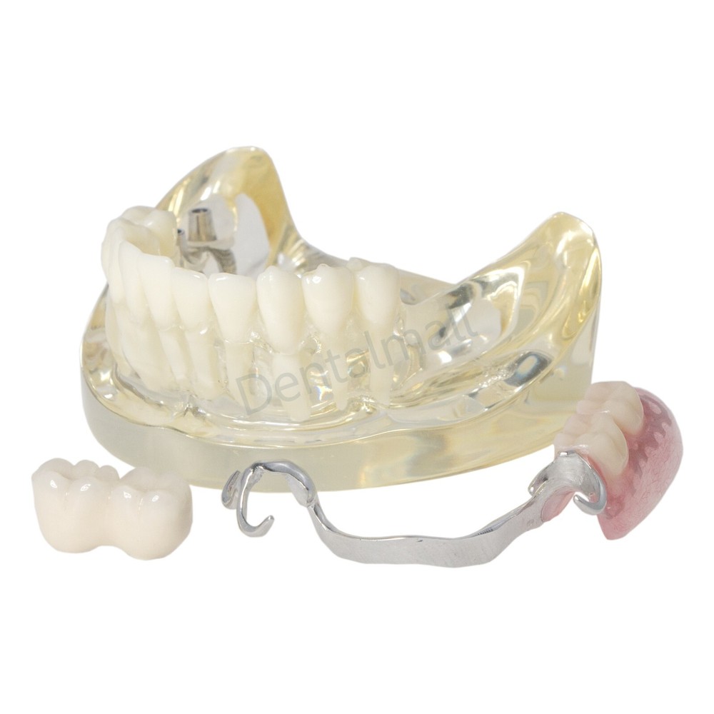 Dental Typodont Restoration Model With  2 Implants Partial Denture Demo