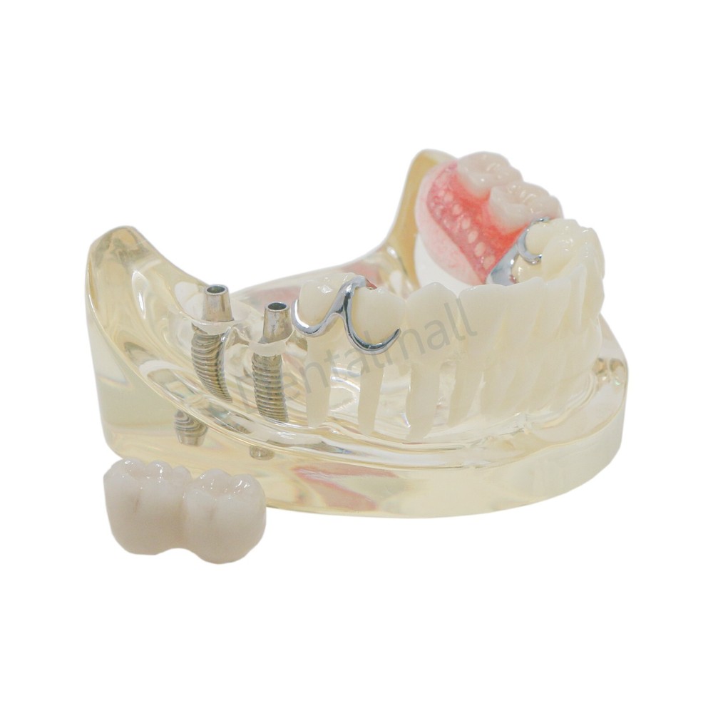 Dental Typodont Restoration Model With 2 Implants Partial Denture Demo