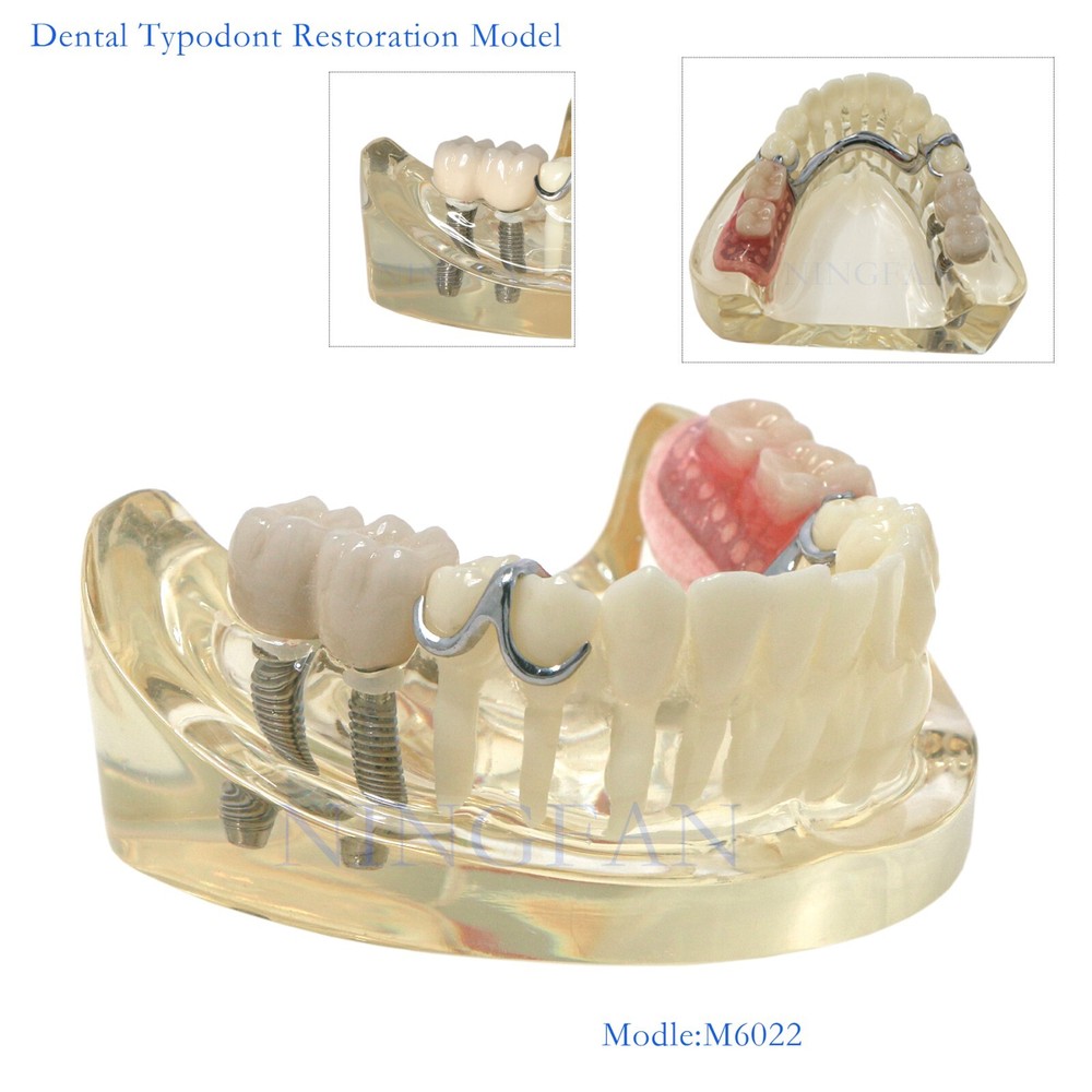 Dental Typodont Restoration Teeth Model With Partial Denture Demo 2 Implants