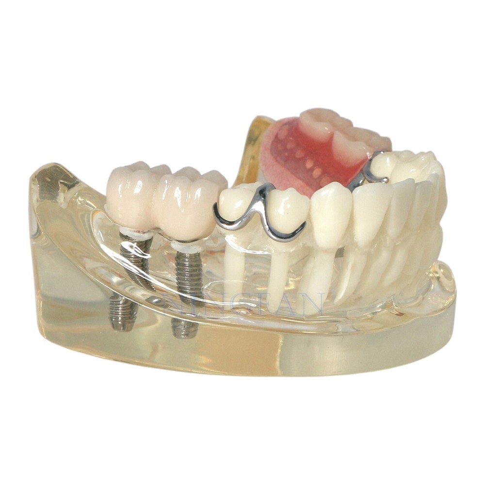 Dental Typodont Restoration Teeth Model With Partial Denture Demo 2 Implants