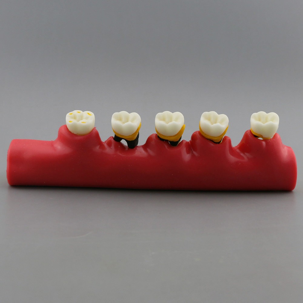 Dental Study Teaching Model Periodontal Disease Assort Teeth Dentoform Typodont