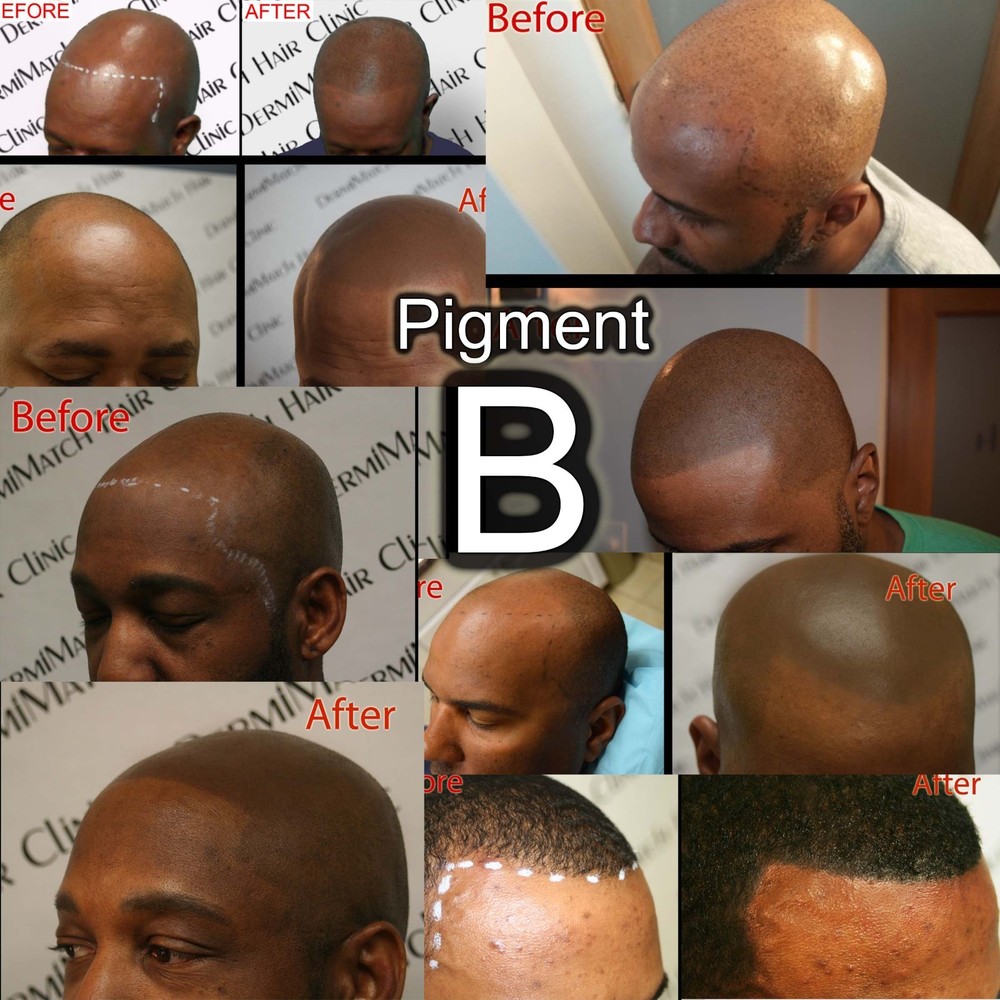 Pigment HD-B - Scalp Micropigmentation Pigment by DermiMatch