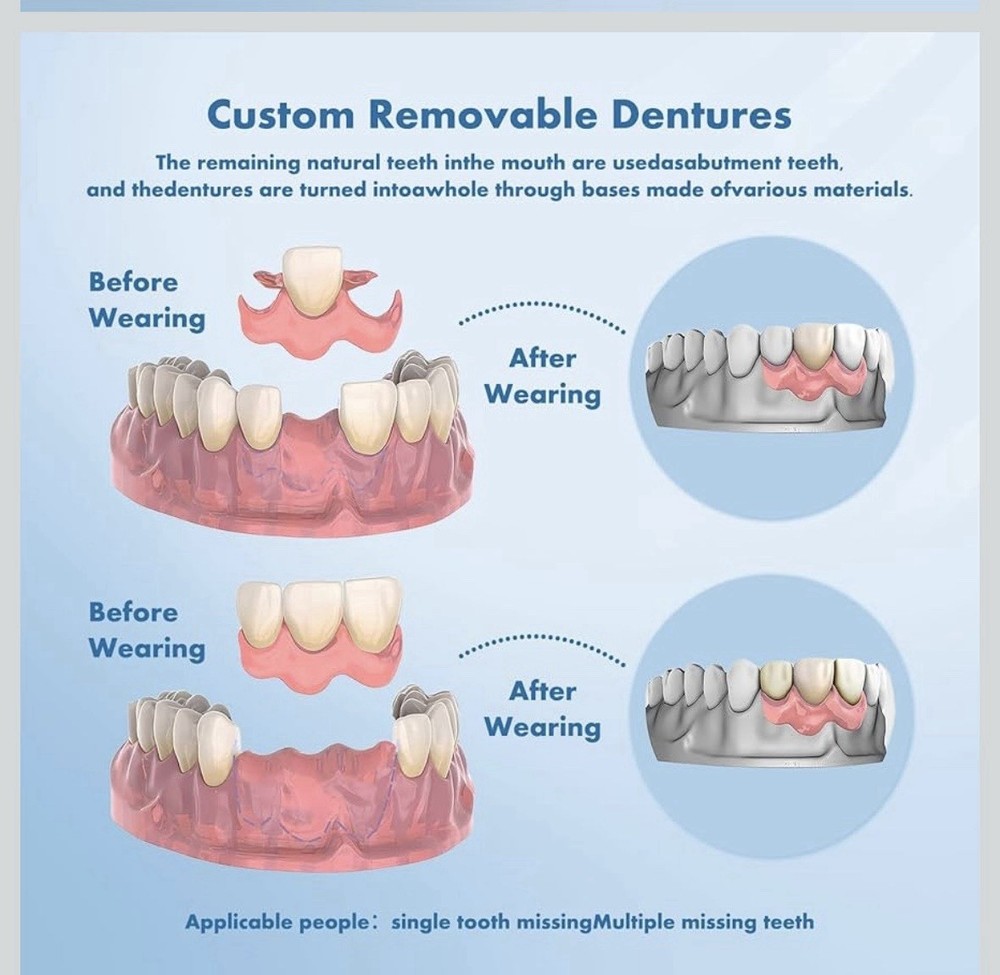 Qiivosm Denture Impressions Kit for Personalized Partial Denture Sets