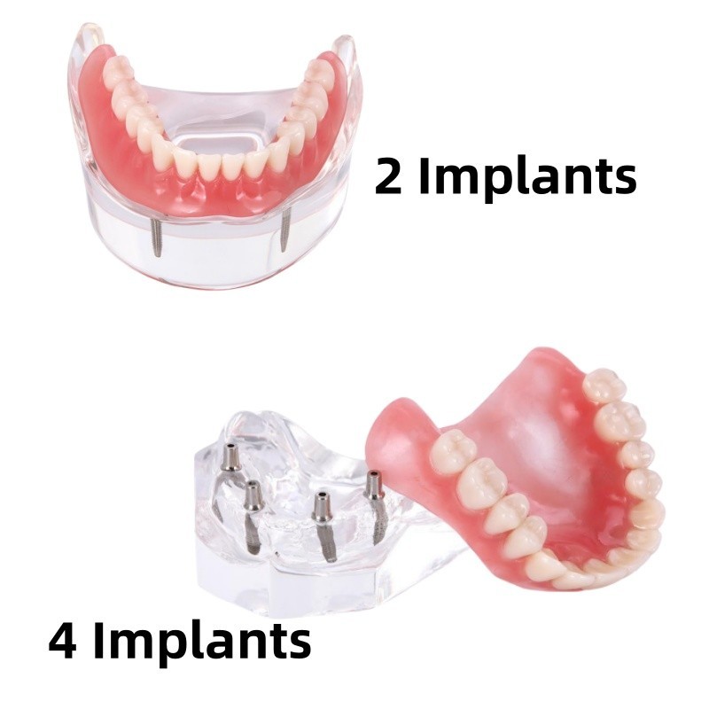 Dental Implant Teeth Model Removable Demo Overdenture Restoration Study Implants