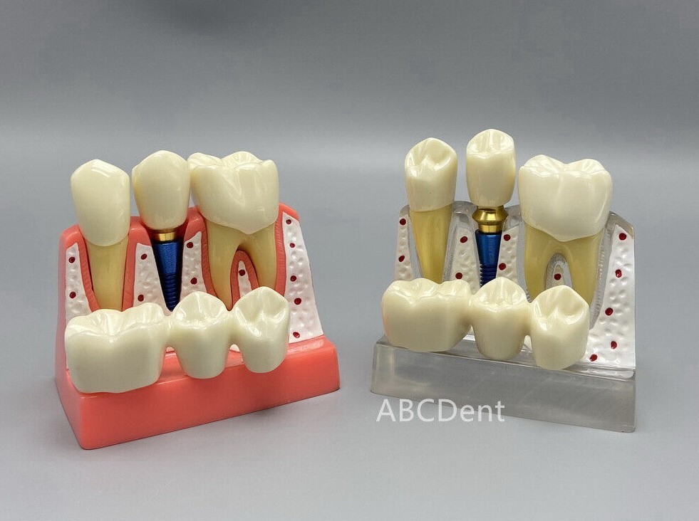 Dental Implant Teach Crown Bridge Analysis Removable Model Demonstration  Study