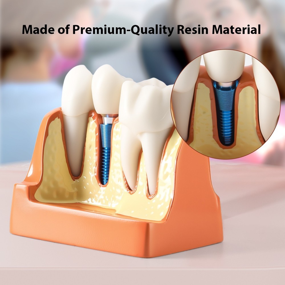 4 Times Dental Teeth Model Implant Crown Bridge Removable Study Teaching Tool