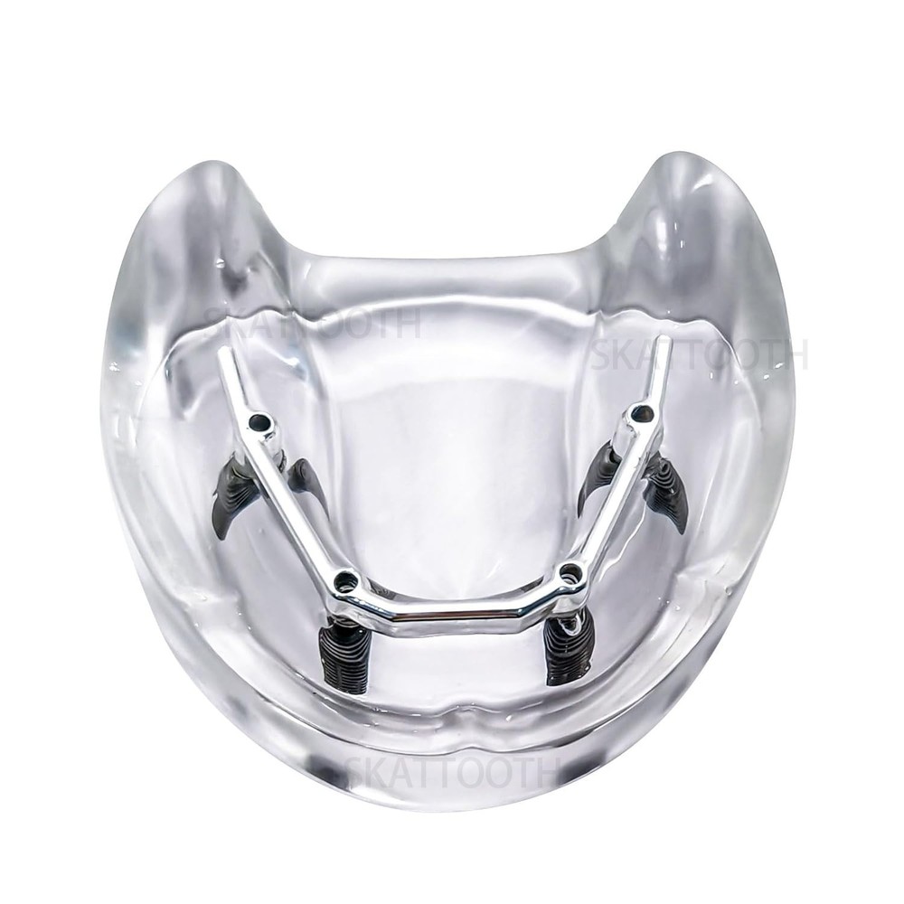 Dental Implant Teeth Model with Silver Bar Typodont Overdenture Teaching Model