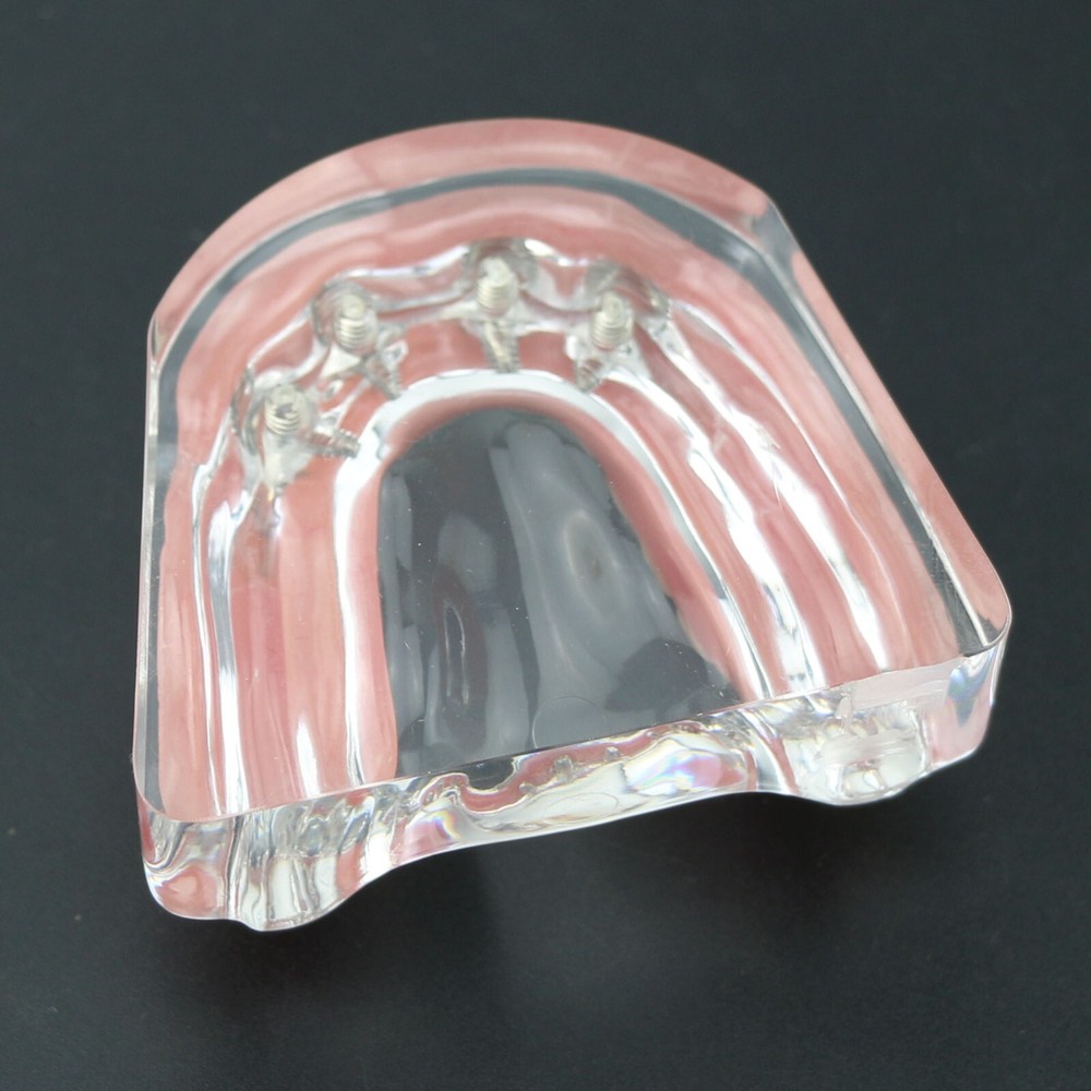 Detal Typondont Implant Teeth Model 4 Implants With Silver Golden Bar