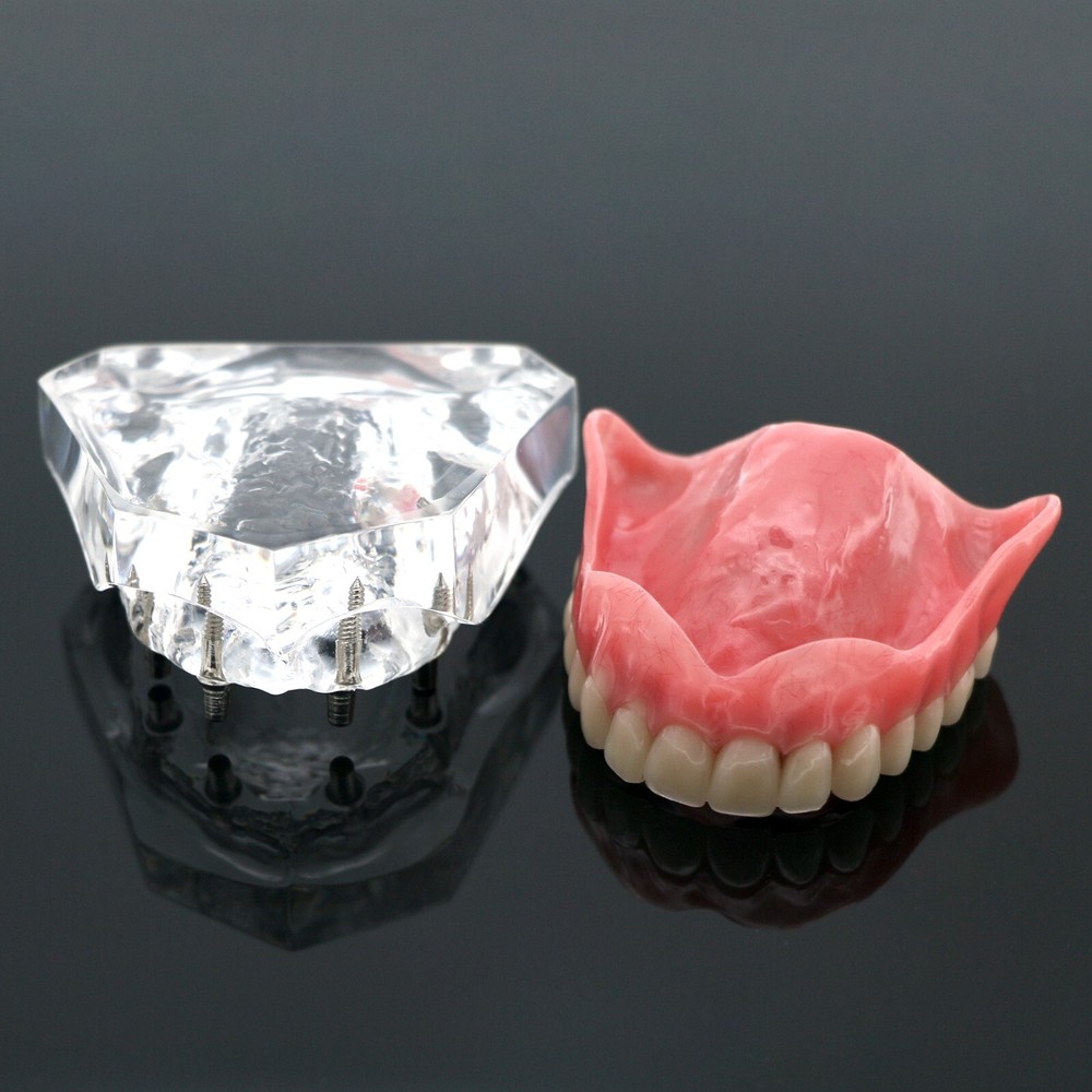 Dental Typodont Implant Overdenture Teeth Model 4 Implants Upper Lower