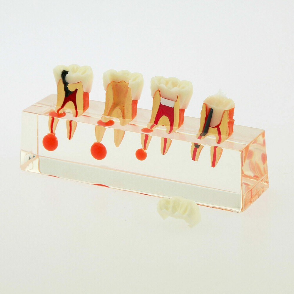 1 Pc Dental Study Typodont Teeth Model #4018 4 Stage Endodontic Treatment Model