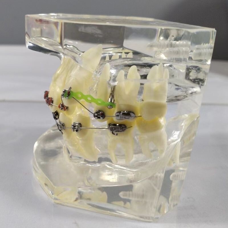 Dental Typodont Orthodontic Treatment Malocclusion Study Model w Brackets Chain