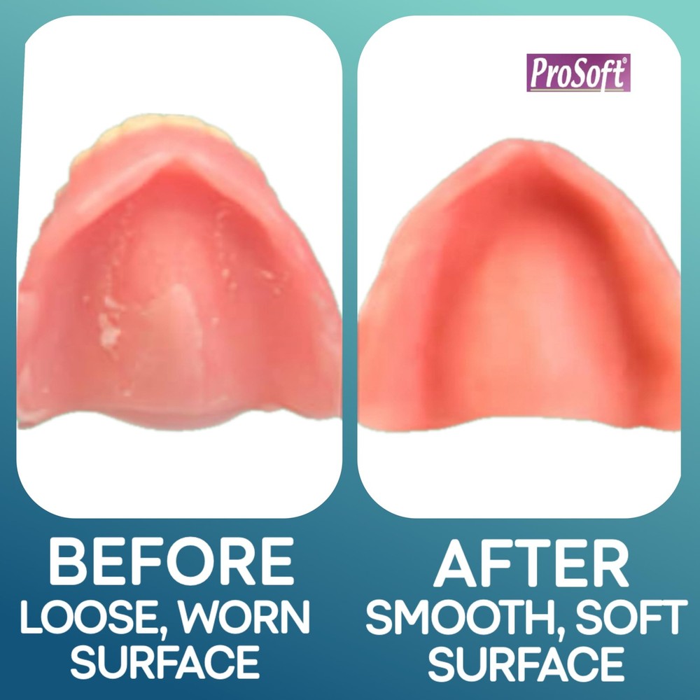 ProSoft Denture Reliner-Relines 2 Denture Plates