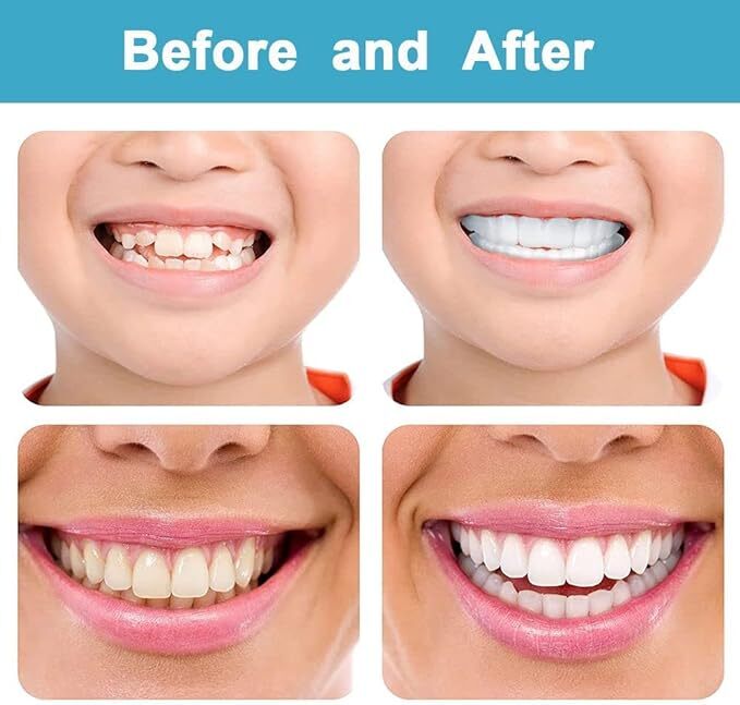 Top and Bottom False Teeth Cover the Broken and Missing Tooth Snap on Instant