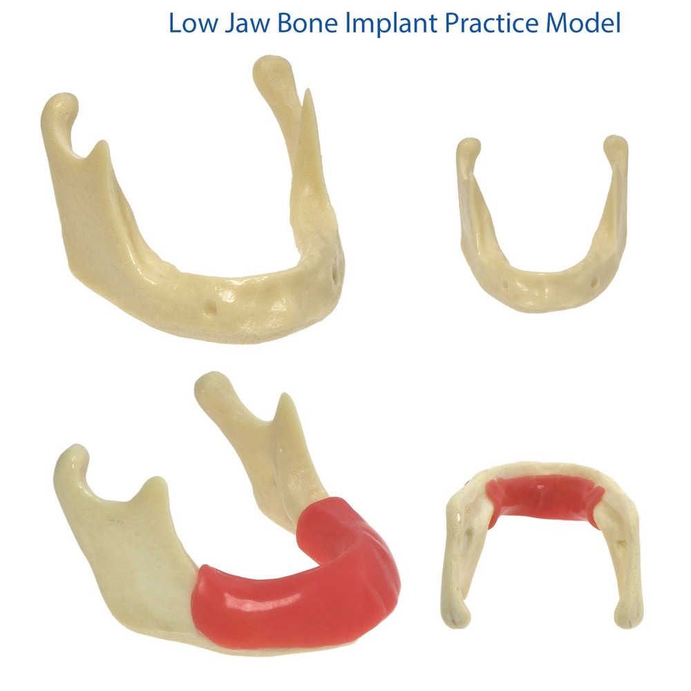 Dental Mandible Implant Jaw Bone Model For Practice Basic Drilling Insertion