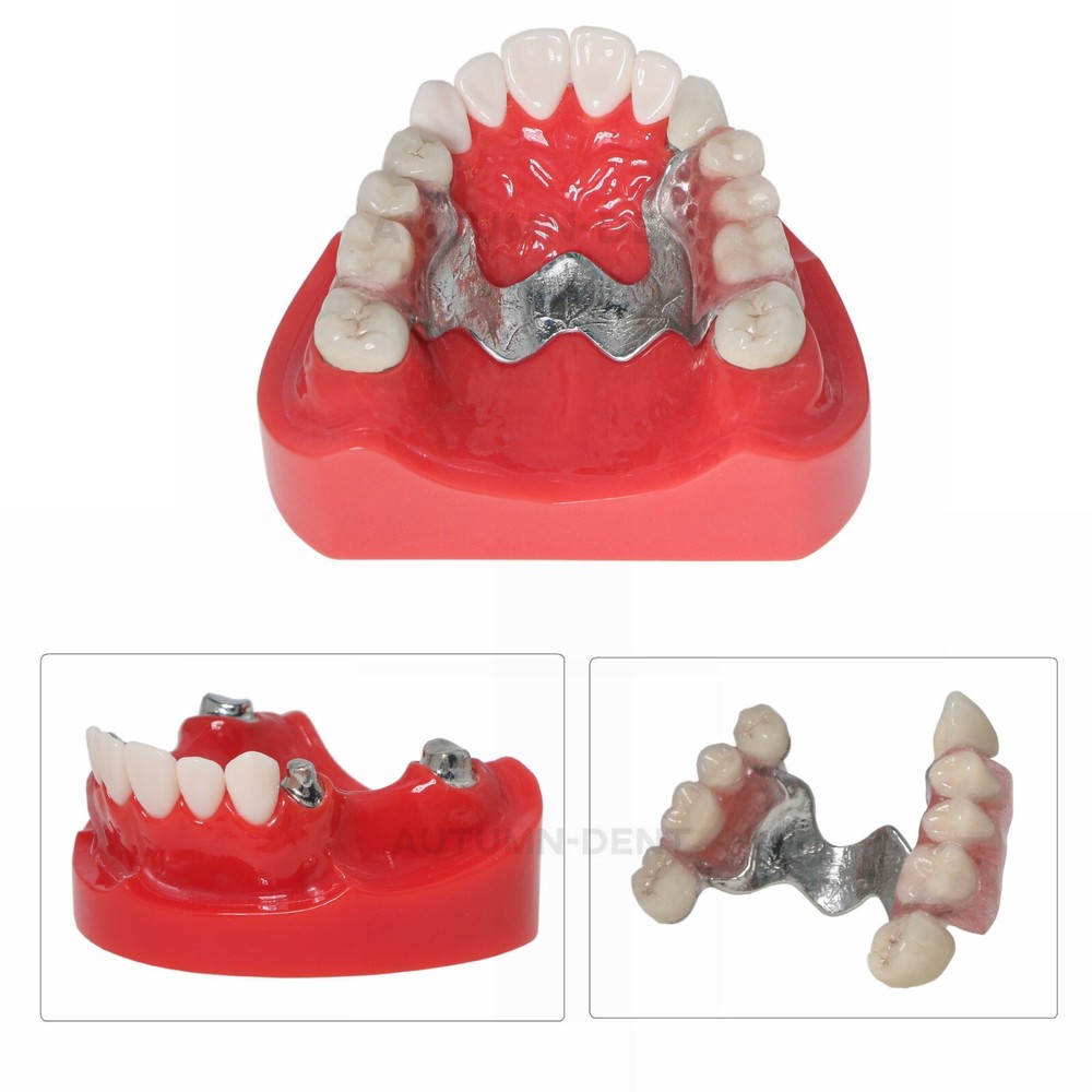 Dental Overdenture Typodont Teeth Model Telescope Crown Prosthetics Model M6010