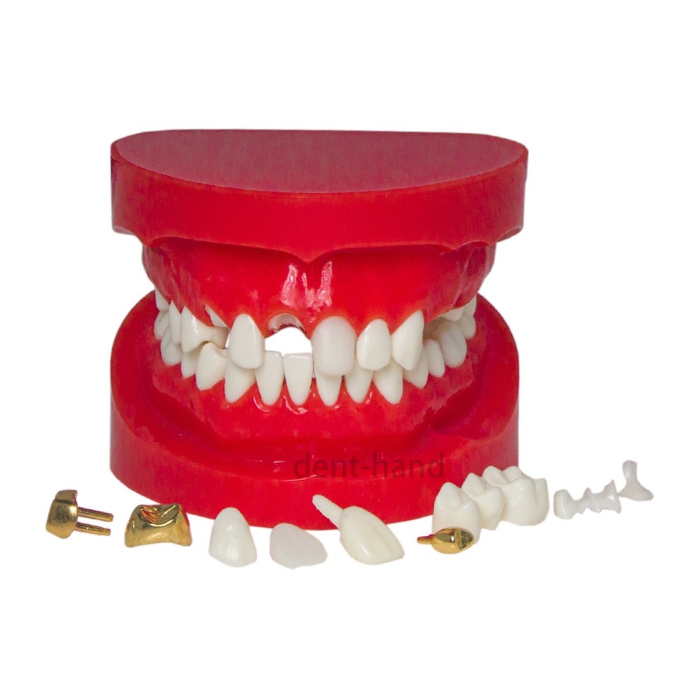 Dental Typodont Teeth Model Restoration Crown with Post Core Bridge M6004