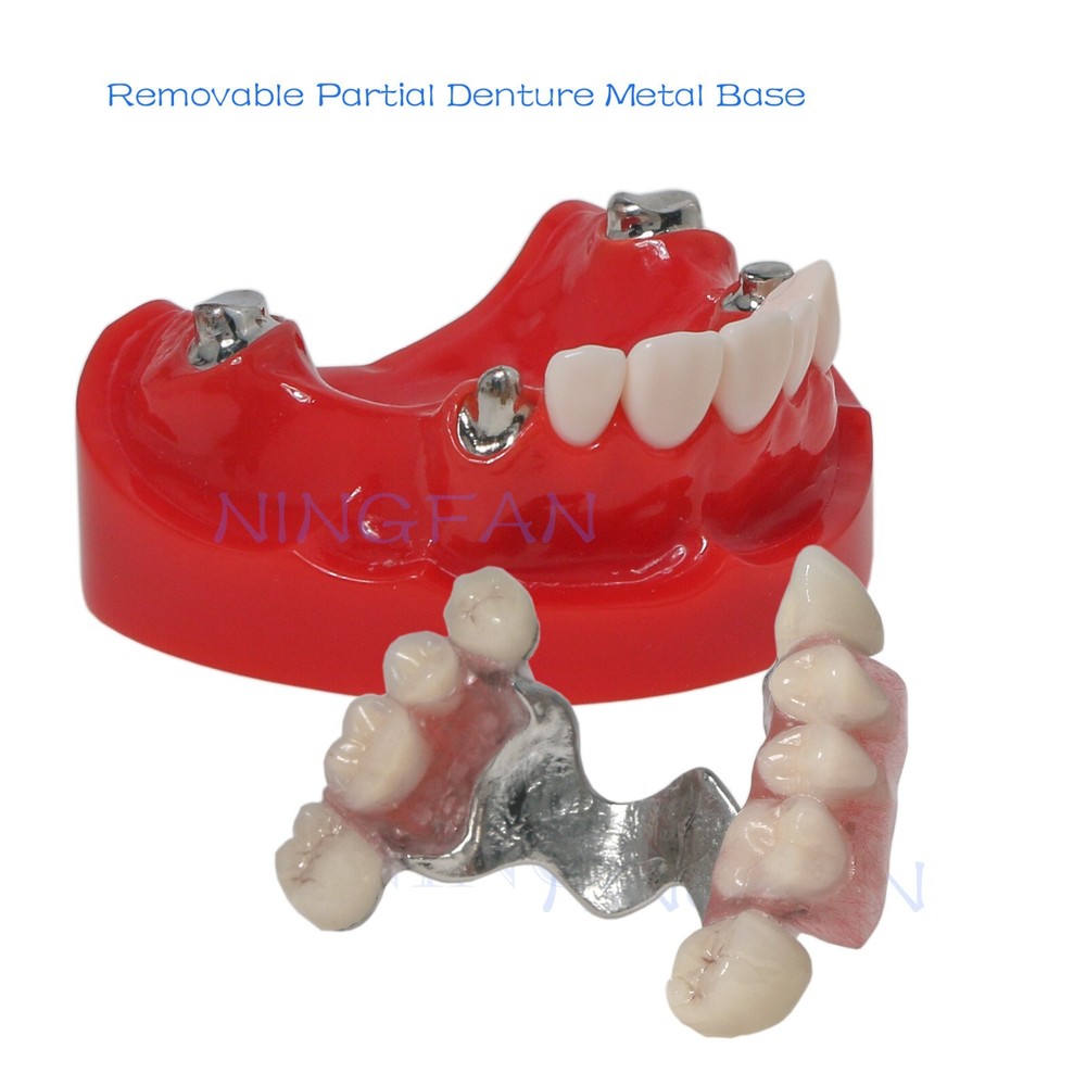 Dental Typodont Removable Partial Denture Model ,PRD Telescopic Crown Denture
