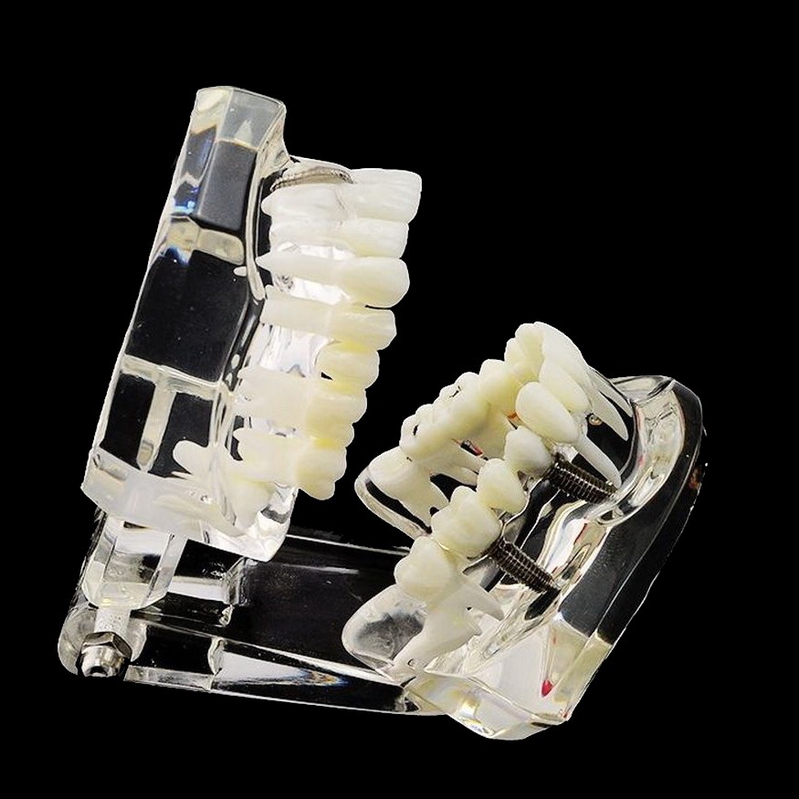 Dental Implant Disease Study Teaching Teeth Model Restoration Bridge Tooth Analy