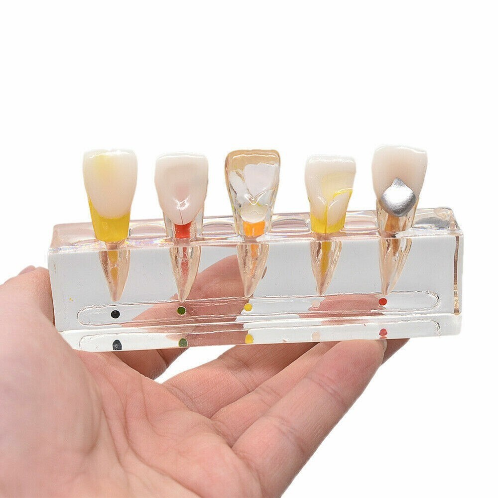 Dental Endodontic Pathology Study Model Demonstration Treatment Anterior Tooth