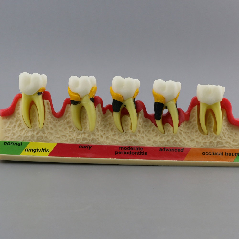 Dental Study Teaching Model Periodontal Disease Assort Teeth Dentoform Typodont