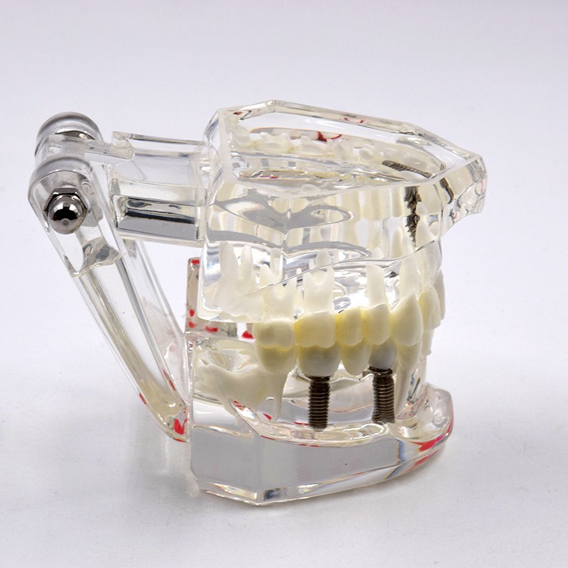 Dental Removable Restoration &Implant Pathological Disease Teeth Study Model