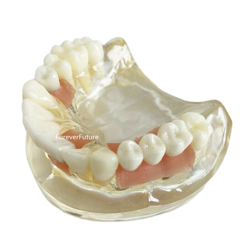 Dental Teeth model with Maryland Bridge Caries Teach Study Model