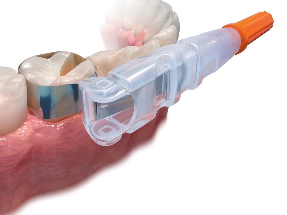 Dental Orange Adjustable Matrix System Sectional Contoured Matrice Roll Type