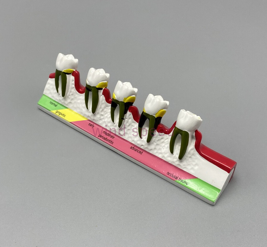 Dental Teeth Dentoform Typodont Caries Periodontal Disease Study Teaching Model