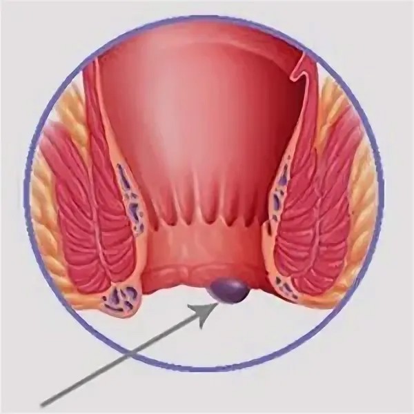 Hemorrhoid Natural Treatment. Extra Strength, for Internal & External Symptoms.