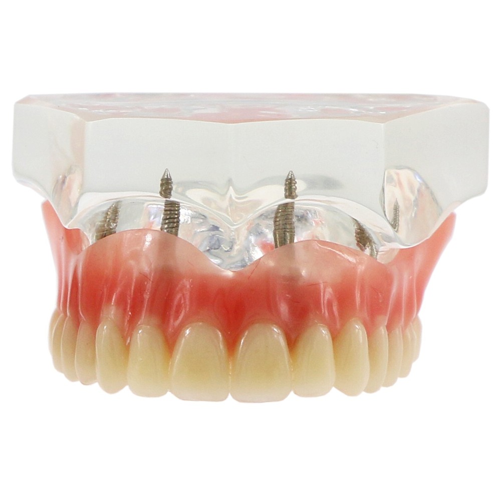 Detal Typondont Restoration Implant Overdenture Teeth Model 2 4 Implants