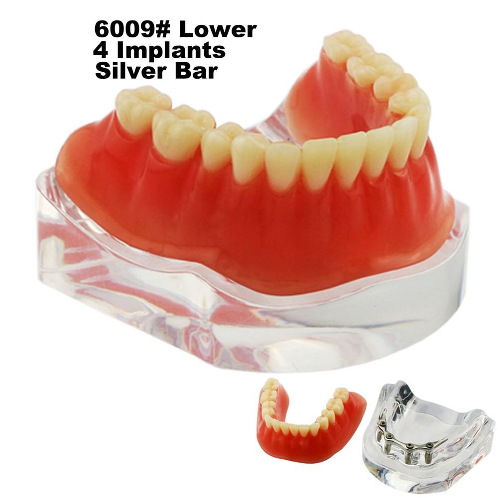 Dental Teeth Model 2 4 Implant Overdenture Typodont Restoration Demo Upper Lower