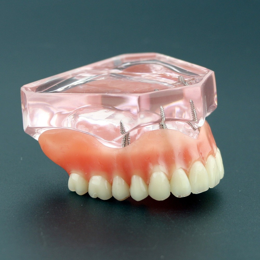 Dental Implant Overdenture Upper Superior Model Precision 4 Maxillary