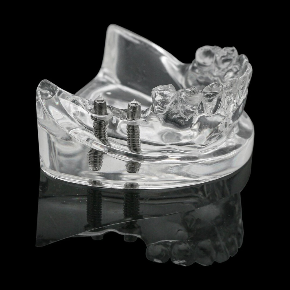 Dental Typodont Model M6022-C w/ Partial Denture 2 Demo& Implants Restoration