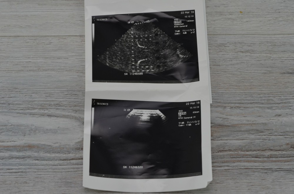 Siemens Acuson 4V2 Vector Array Transducer / Probe for Acuson Aspen Ultrasound