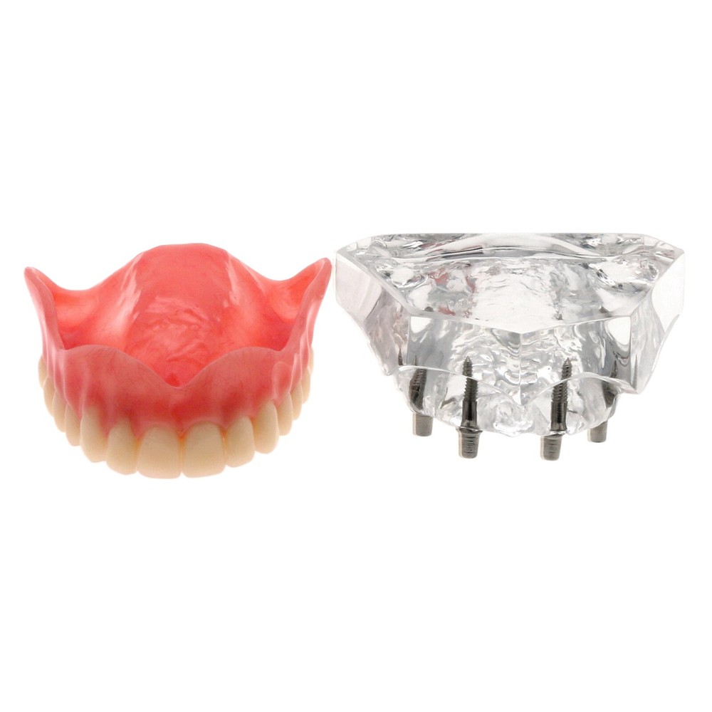 Dental Typodont Implant Overdenture Teeth Model 4 Implants Upper Lower