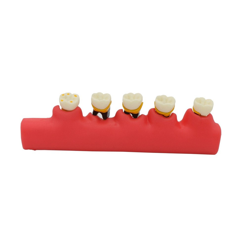 Dental Pathological Typodont Teeth Model Periodontics/Implant/Endodontic Caries