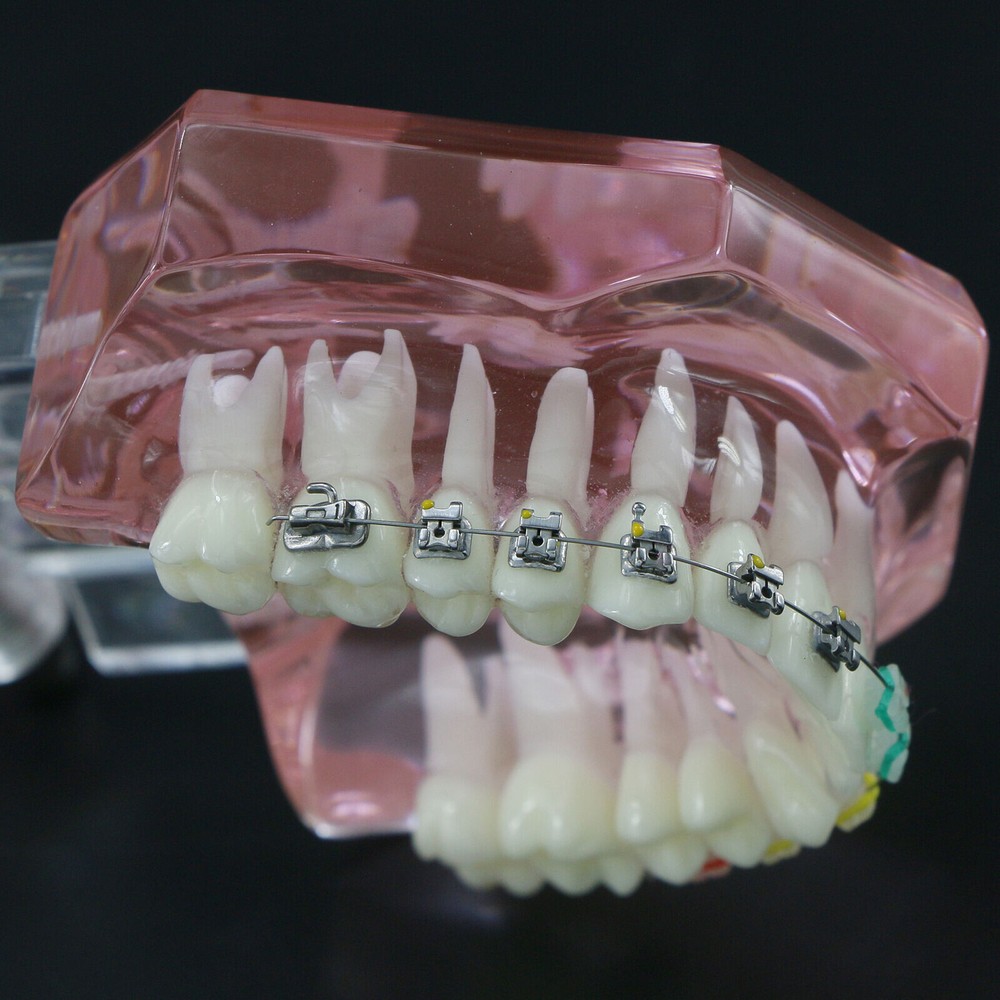 Dental Typodont Model Self-ligating Metal Bracket Ceramic Transparent Retainer