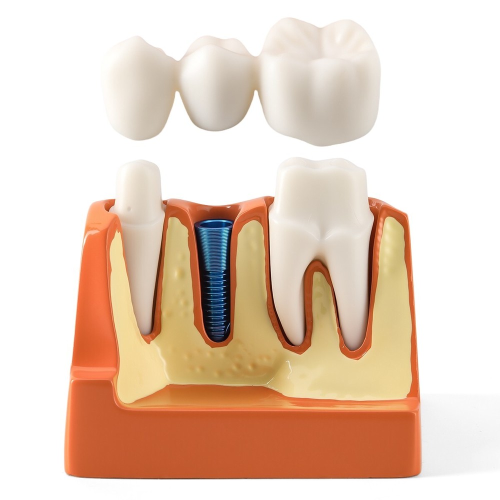4 Times Dental Analysis Crown Bridge Demonstration Removable Teaching Model