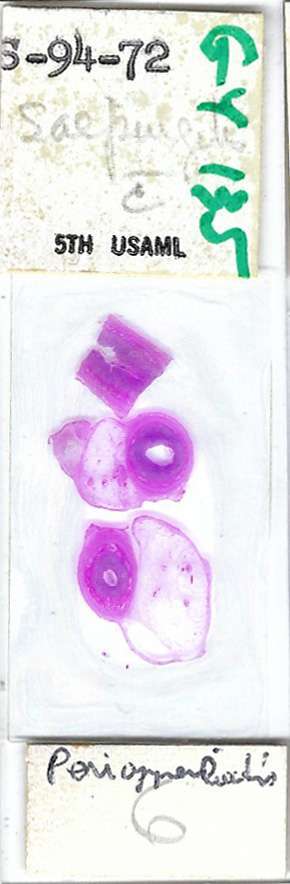 Human Salpingitis with Periappendicitis Pathology Microscope Slide