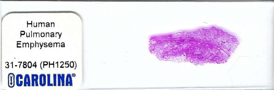 Human Pulmonary Emphysema Pathology Microscope Slide