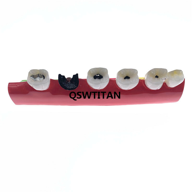 Dental Caries Classify/Evolution model Tooth Model Dental Study Model
