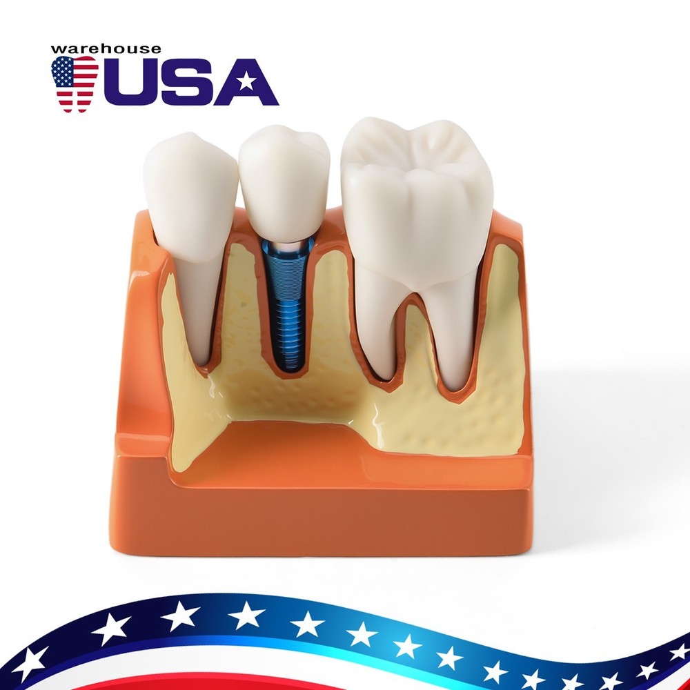 4 Times Dental Teeth Model Implant Crown Bridge Removable Study Teaching Tool