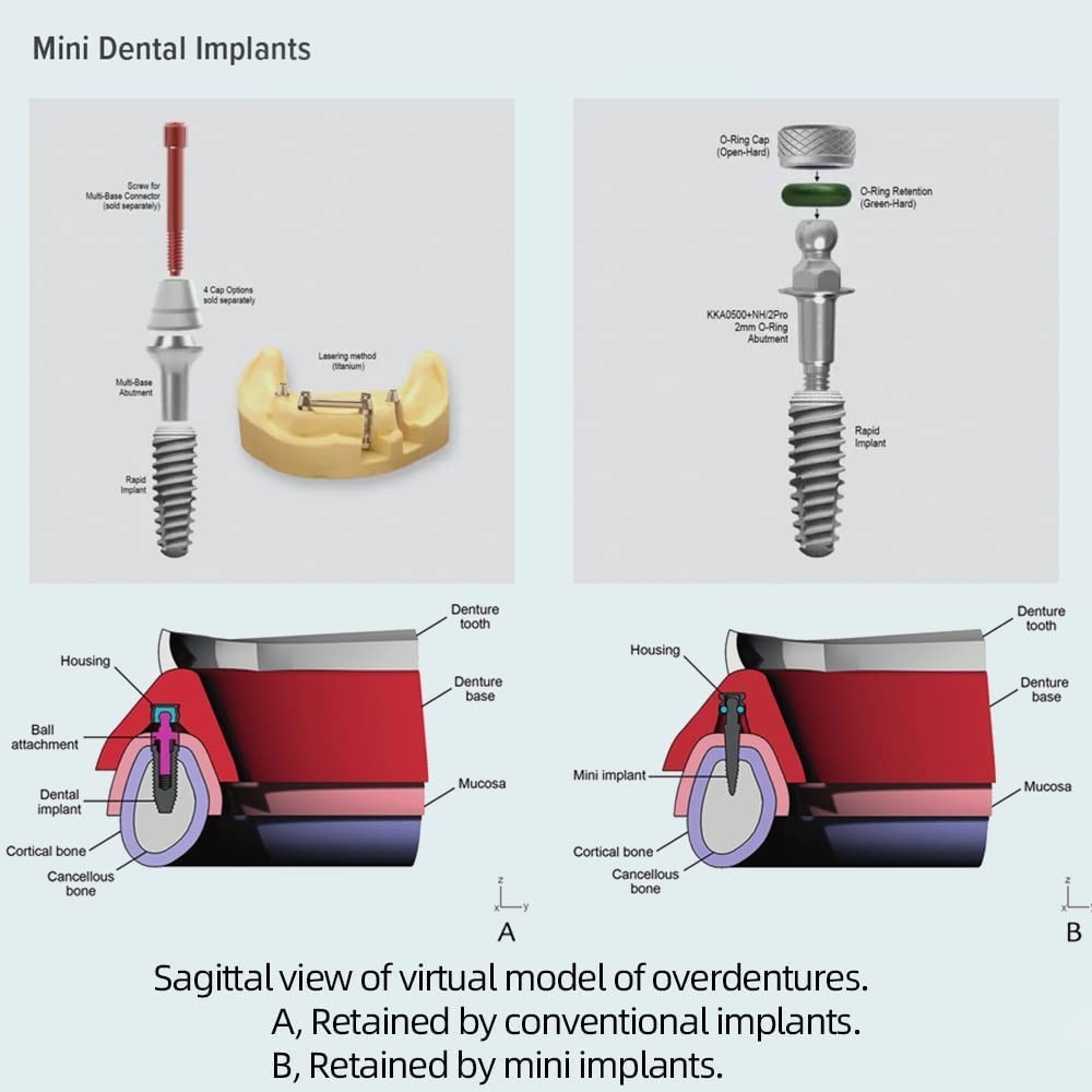 O-Ring Mini Dental Implants Replacement 3 Convenient Sizes with Tool Kit
