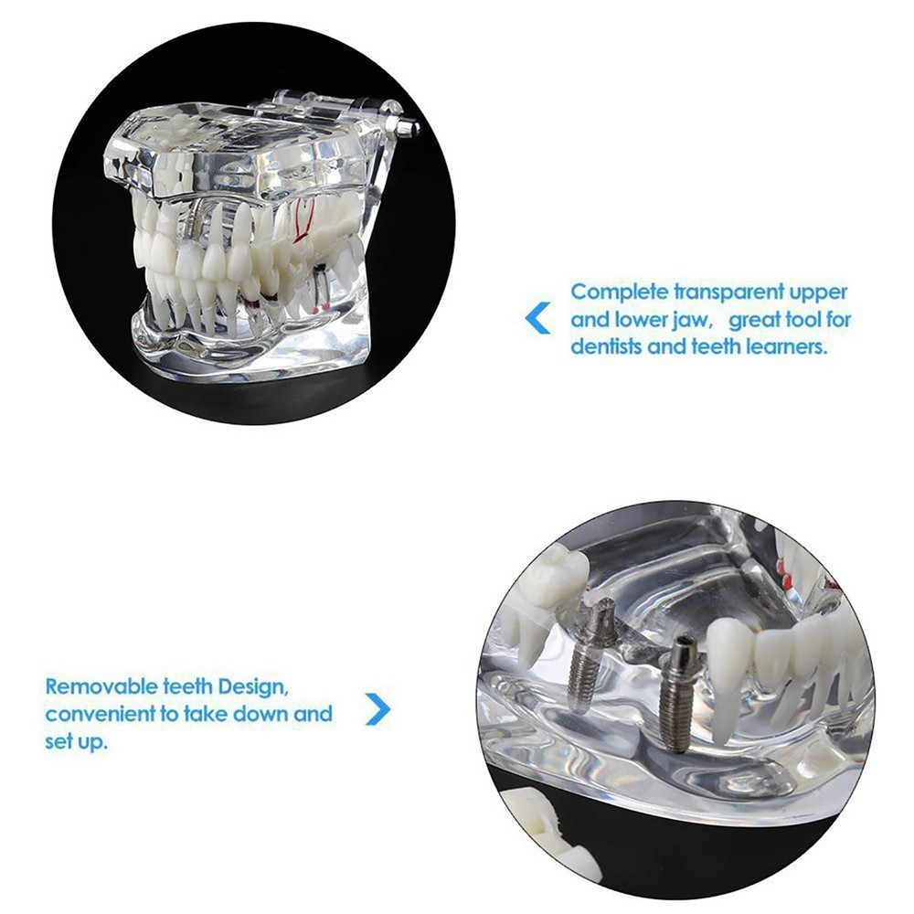 Dental Removable Restoration &Implant Pathological Disease Teeth Study Model