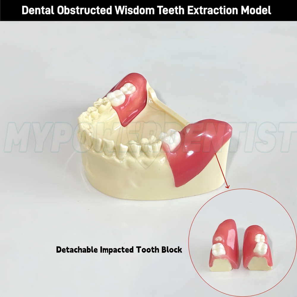 Dental Obstructed Wisdom Teeth Extraction Model Lower Soft Gingiva Wisdom Model