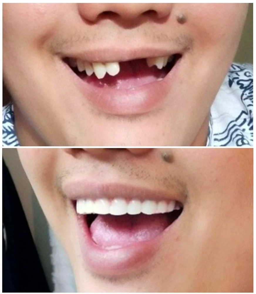 Comfort Fit Flex Dental Veneers